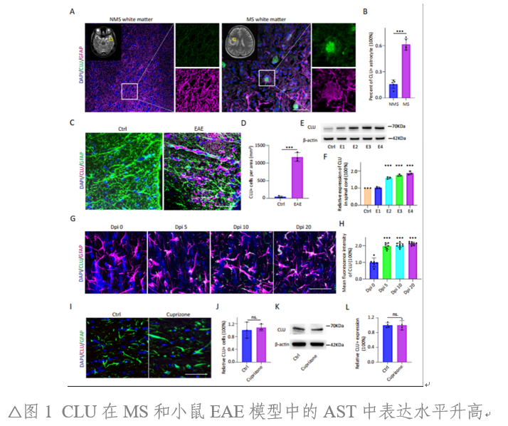中山大学附属第三医院脑病中心联合香港中文大学揭示多发性硬化髓鞘再生障碍新机制