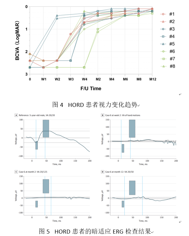 中山大学丁小燕团队发现一种新的眼底疾病——超急性视网膜外层功能障碍（HORD）