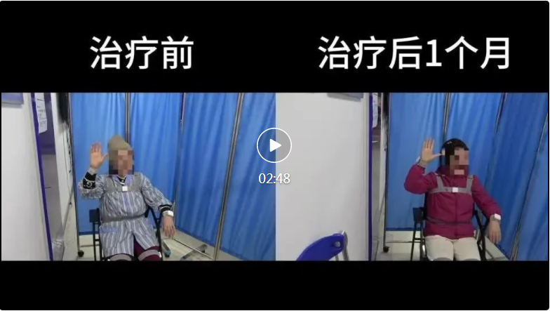 附属瑞金医院创新帕金森病疗法，国内首例接受该疗法的患者“走”向康复