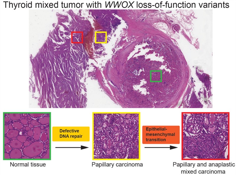 研究发现WWOX基因胚系失活突变促进甲状腺癌发生发展新机制
