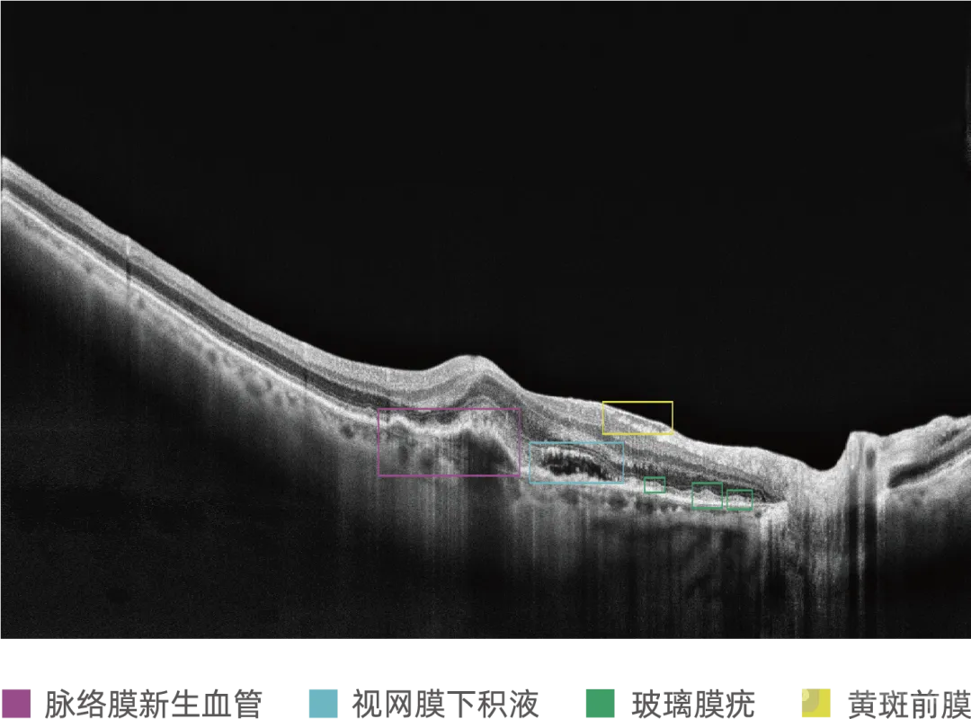 电子科技大学医学院陈新建教授团队获得全球首张医用OCT AI三类证
