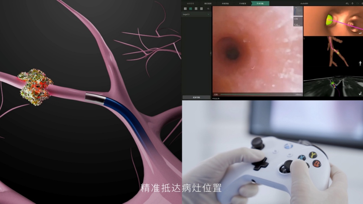 清华大学生医工程学院廖洪恩领衔的“经呼吸道多模式智能精准诊疗机器人系统研发”项目获得三类医疗器械注册证