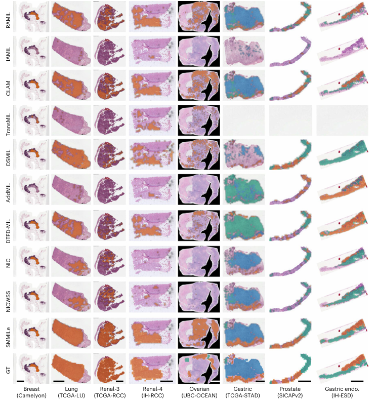 西安交大与剑桥大学联合发明全球首个 可实现大规模肿瘤筛查及细粒度量化诊断的人工智能病理模型