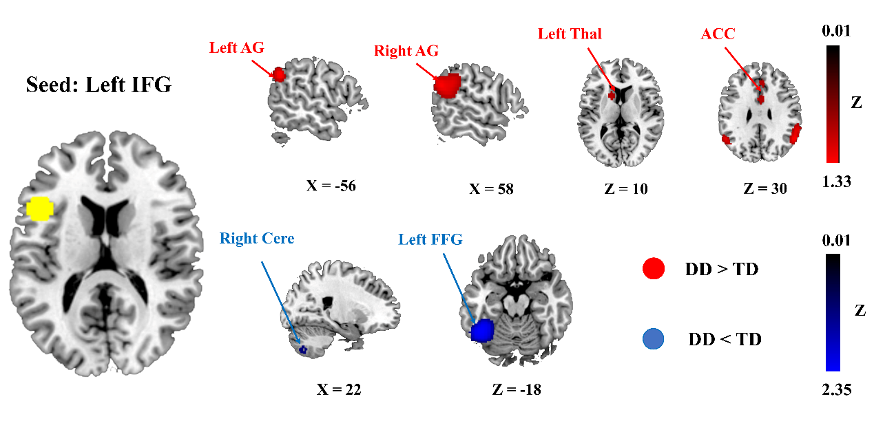 研究揭示发展性阅读障碍跨模态脑功能连接异常