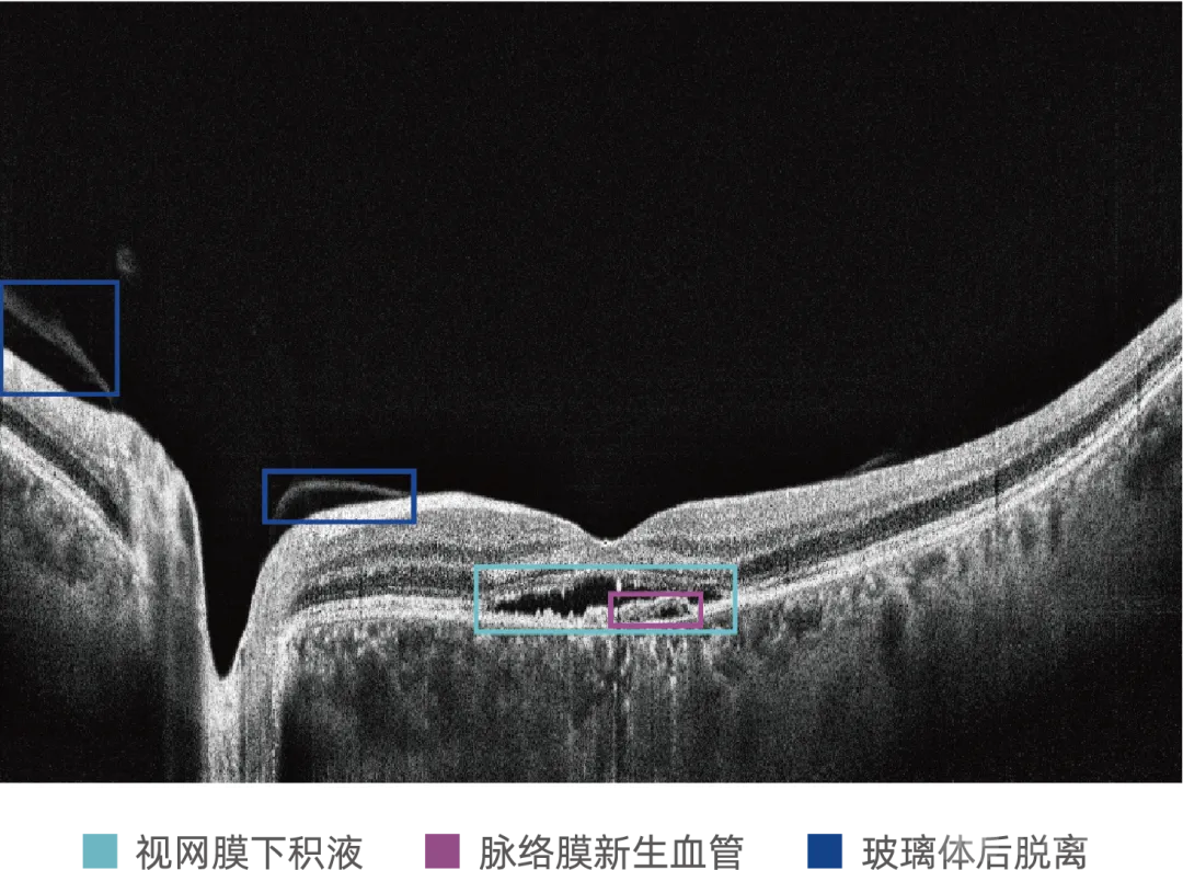 电子科技大学医学院陈新建教授团队获得全球首张医用OCT AI三类证