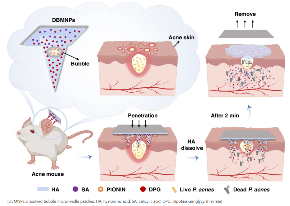 清华大学深圳国际研究生院张灿阳团队在微针透皮给药领域取得新进展