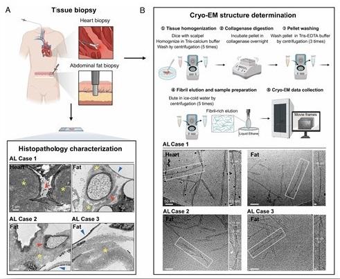 上海交大Bio-X研究院李丹团队与合作者开发基于病理聚集体的轻链淀粉样变性病活检诊断新方法