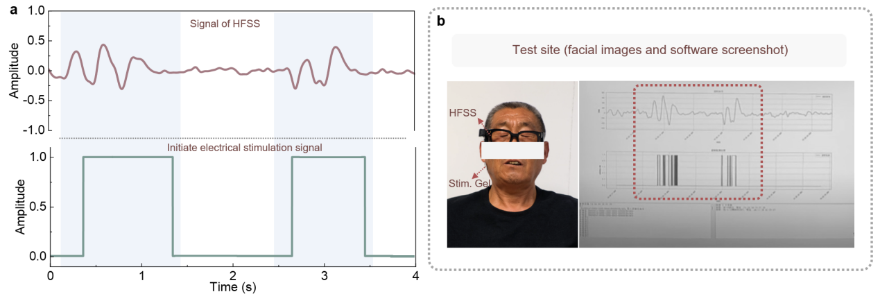 清华大学生医工程学院李翀团队合作实现基于非侵入式神经刺激的面肌痉挛监测及干预新途径