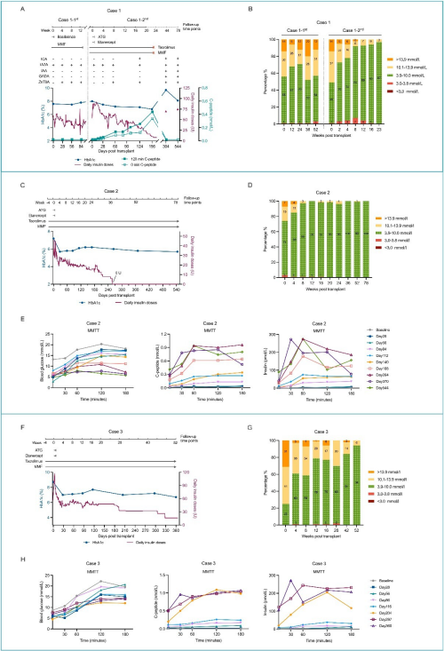 科研人员利用自体/异体再生胰岛移植治愈1型糖尿病