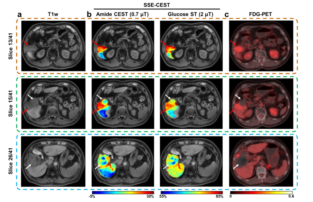 清华大学生医工程学院宋小磊团队合作研发单次屏气腹部3D高清代谢核磁共振成像