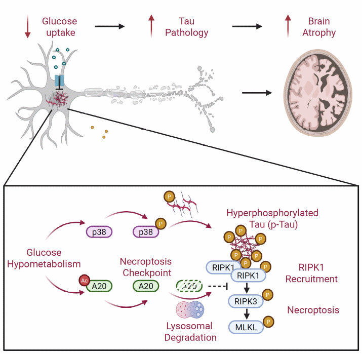 研究人员解析阿尔茨海默病关键病理特征协同致病机制